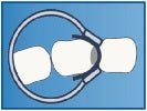 D Ring (Tines Are Curved Inwards To Fix Matrix On A Distal Side of The Tooth)