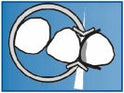 MD Ring (Non-Fluctuating Placement with Sufficient Space for Wedge)