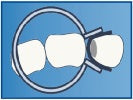 M Ring (Tines Are Curved Out To Fix Matrix On Mesial Side of The Tooth)