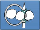 Delta Ring (Suitable for Installation of Fixing Wedges and Add-On Wedges)