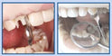 Matrices for Front Teeth Restoration (Large) 12pcs