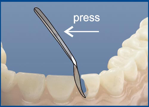 Matrices for Front Teeth Restoration (Medium) 12pcs