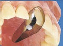 Twin Anterior Matrices (Palatal) 12pcs