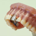 Twin Anterior Matrices (Palatal) 12pcs