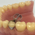 Metal Contoured Matrices for Molars Combined with Clamp 10pcs