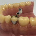 Metal Contoured Matrices for Molars Combined with Clamp 10pcs